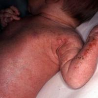 
	Incontinentia pigmenti - stage 1