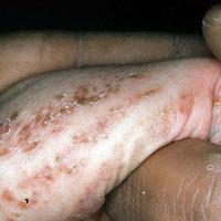 
	Incontinentia pigmenti - stage 2