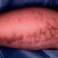 
	Incontinentia pigmenti - stage 3