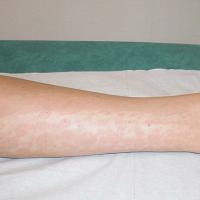 
	Incontinentia pigmenti - pigmentation faded
