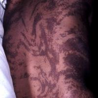 
	Incontinentia pigmenti