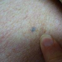 Shrapnel mimicking a blue naevus&nbsp;Copied with…