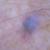 Dermoscopic appearance of previous figureCopied…