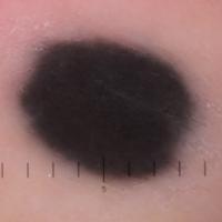 Dermoscopic appearance of previous…