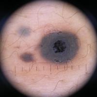 Dermoscopic appearance of previous…