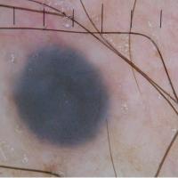 Dermoscopic appearance previous…
