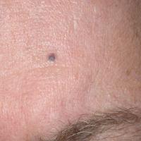 
	Blue naevus on the forehead
	
	The lesion had…
