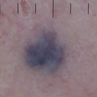 Dermoscopic appearance of previous…