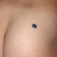 
	Cellular blue naevus on the buttock
