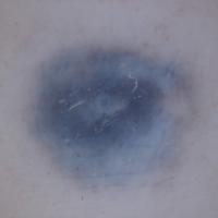 Dermoscopic appearance of previous figure