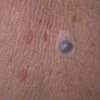 
	Nodular melanoma

	This lesion showed…