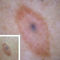 A combined naevusThis lesion was stable (not…