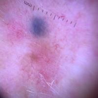 Dermoscopic image of previous figure