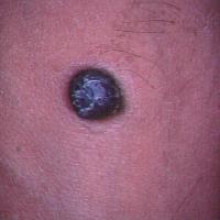 
	Nodular melanoma
	
	This lesion showed…