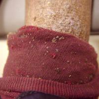 
	Body lice

	Note the skin hyperpigmentation…