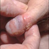 
	Bowen's disease of the penis

	Warty…