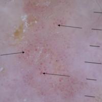 Dermoscopic appearance of figure 5Grouped…
