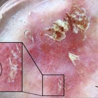 Bowen's diseaseClose inspection reveals that some…