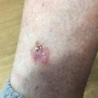 Bowen's disease