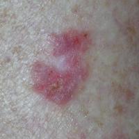 Bowen's disease of the calf - close upCopied with…