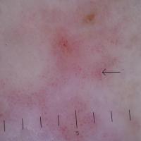 
	Dermoscopic appearance of figure 3

	Grouped…