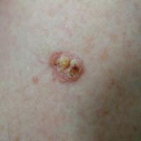 Bowen's disease&nbsp;The scale was removed from…