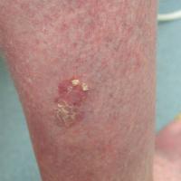 Bowen's disease of the calfA classical lesion -…