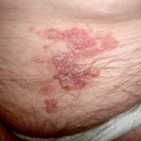 
	Bowen's disease on the lower abdomen, an…