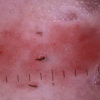 Dermoscopic appearance of previous…