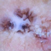 Pigmented Bowen'sBrown and white structureless…