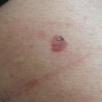 Pigmented Bowen's disease&nbsp;Copied with kind…