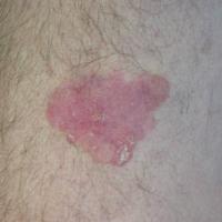Bowen's disease - a large patchSome lesions can…