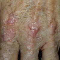 
	Epidermolysis bullosa acquisita

	Copied with…