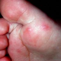 
	Hand, foot and mouth disease