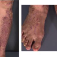 
	Pretibial epidermolysis bullosa