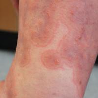 
	Bullous pemphigoid

	Copied with kind…
