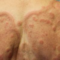 
	Bullous pemphigoid

	Same case as previous…