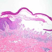 
	Bullous pemphigoid - histopathology

	There is…