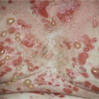 
	Bullous pemphigoid