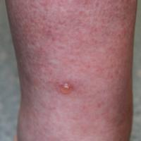 
	Bullous pemphigoid

	The same patient as…