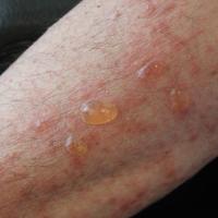 
	Bullous pemphigoid 