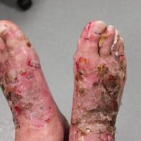 
	Bullous pemphigoid - localised