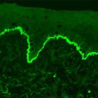 
	Bullous pemphigoid - direct…