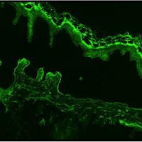 
	Bullous pemphigoid - salt-split skin assay…