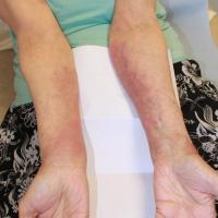 
	The pre-bullous phase&nbsp;

	Fixed, itchy,…