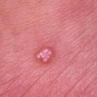 
	Pilomatricoma