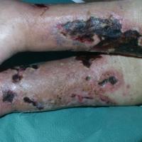 
	Calciphylaxis

	Advanced changes