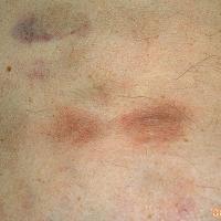 
	Metastatic calcification

	Copied with kind…