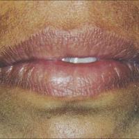 
	Angular cheilitis with proven candida infection