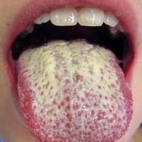 
	Oral candidiasis